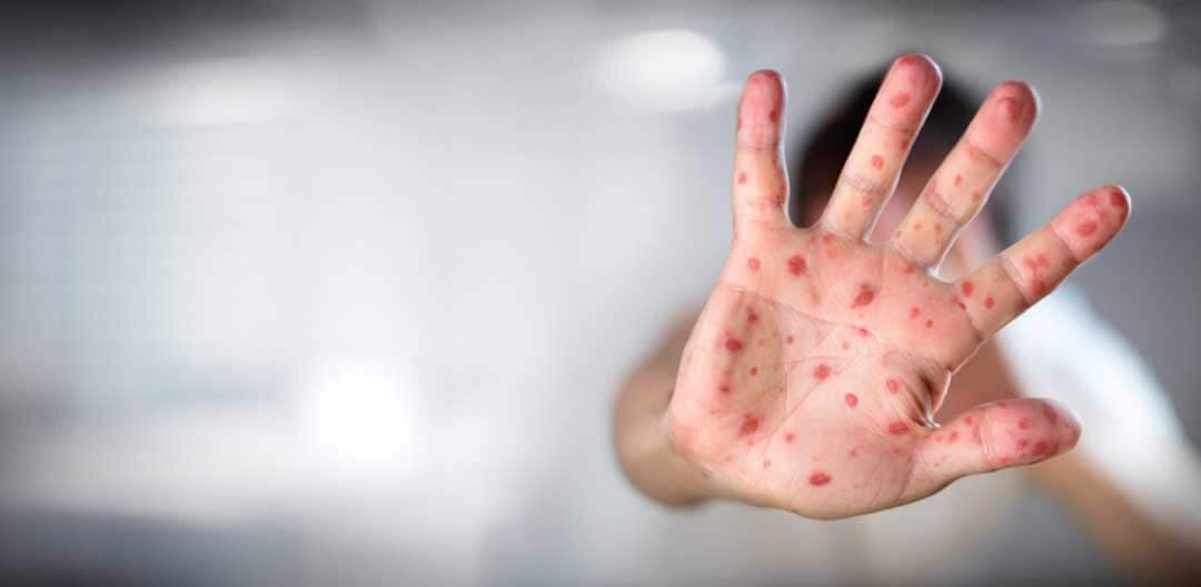 Volta do Sarampo ao Brasil - Doutor Aprende