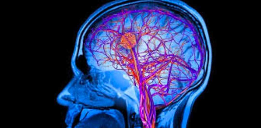 Demencia vascular - Doutor Aprende