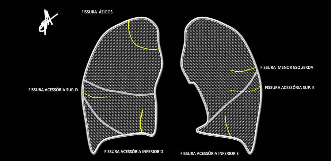 Fissura pulmonais acessorias - Doutor Aprende