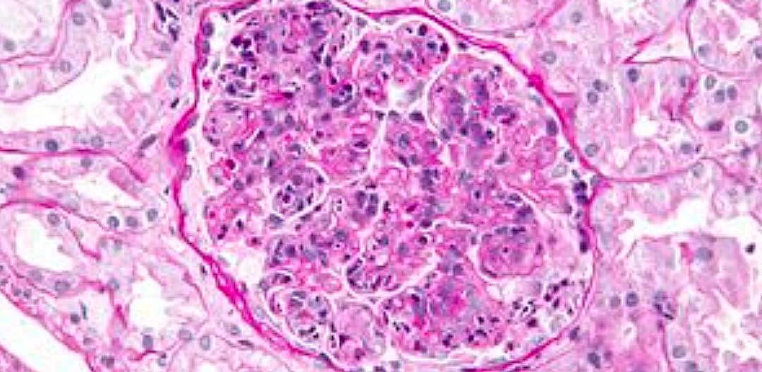 Glomerulonefrite pos estreptococica - Doutor Aprende