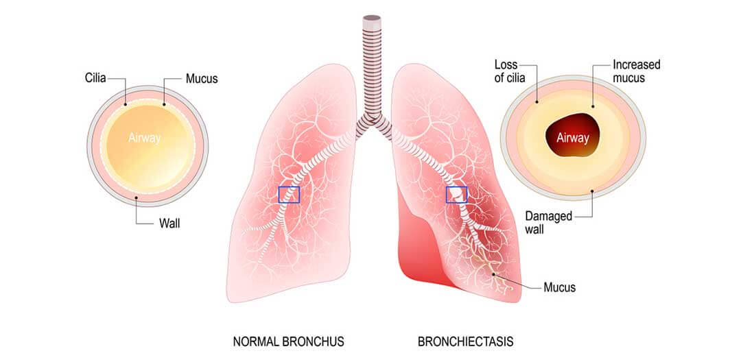 Bronquiectasia - Doutor Aprende